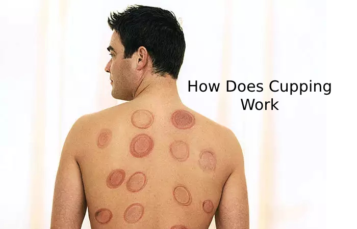 How Does Cupping Work