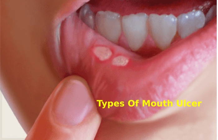 Types Of Mouth Ulcer