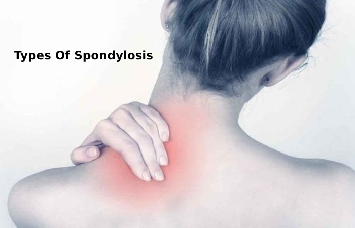 Types Of Spondylosis 