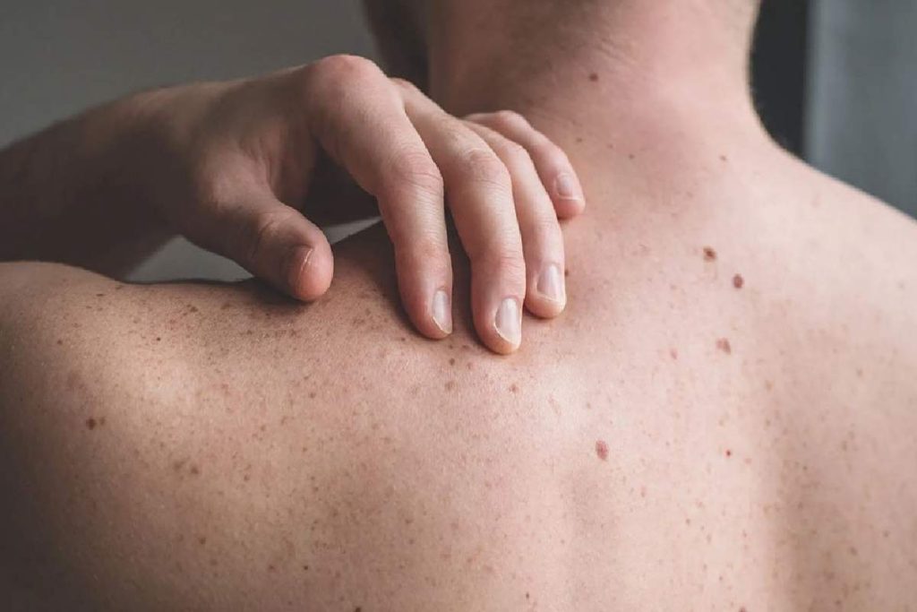Skin Diseases