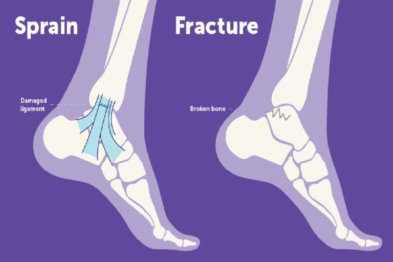 Sprained Ankle Vs Broken Ankle: A Guide to Diagnosis and Treatment
